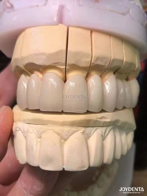 ซื้อ โปรเซลีนที่เหมาะสมอย่างแม่นยําหลอมไปกับโลหะ PFM crowns การผลิตออนไลน์