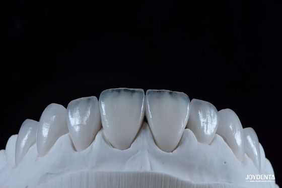 ซื้อ สภาพธรรมชาติ Emax Porcelain Veneer สะดวกสบาย Fit Ultra Thin Emax Veneers การผลิตออนไลน์
