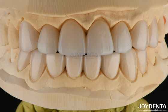ซื้อ 0.3-0.5 มิลลิเมตร หนา Feldspathic Porcelain Veneer ทนต่อการแตกสูง ปรับปรุงรอยยิ้มของคุณ การผลิตออนไลน์