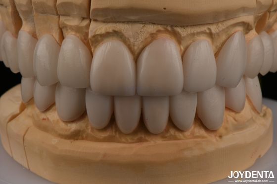 ซื้อ 0.3mm ความหนา Ips Emax Veneers Veneers เซรามิก หน้าหลังหลัง การผลิตออนไลน์