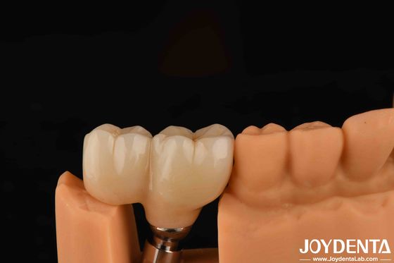 ซื้อ ประเภทเส้นทรง V ปลาย Abutments ความเข้ากันได้กับระบบการปลูกหลักทั้งหมด การผลิตออนไลน์