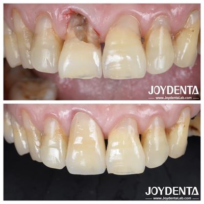 ซื้อ ผิวเรียบฟันฟัน Zirconia Crown สําหรับการซ่อมแซมหลังและหน้า การผลิตออนไลน์