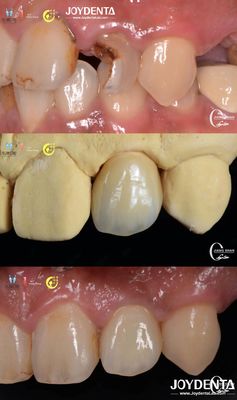 ซื้อ ความเป็นจริงของฟัน ลักษณะของฟัน Zirconia Bridges การฟื้นฟูฟันฟัน ทนทานการสวมใส่ การผลิตออนไลน์