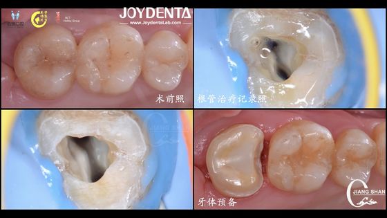ซื้อ ระยะยาว สภาพธรรมชาติ ดูฟัน เซรามิค Inlay ใส่ตรง สะสมสูง การผลิตออนไลน์