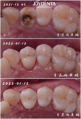 ซื้อ การ ปรับปรุง ฟัน ที่ มี ความ สะดวก ถูกต้อง การผลิตออนไลน์