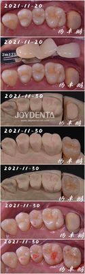 ซื้อ การรักษาฟันแบบปรับปรุงรูปแบบสําหรับการซ่อมฟัน การผลิตออนไลน์