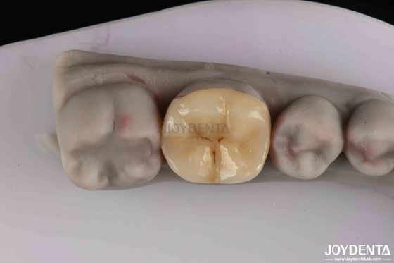 ซื้อ การเตรียมความพร้อมอย่างน้อยสําหรับการฟื้นฟูฟันที่เสียหาย การผลิตออนไลน์