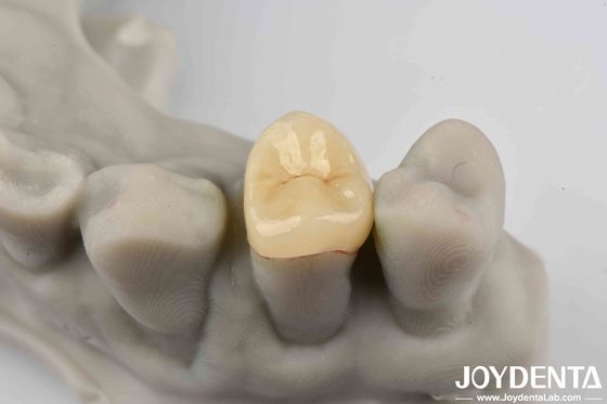 ซื้อ เซมเมนต์ที่ปลอดภัย Emax Inlay Onlay ง่ายในการทําความสะอาดและทนต่อการคราบ การผลิตออนไลน์