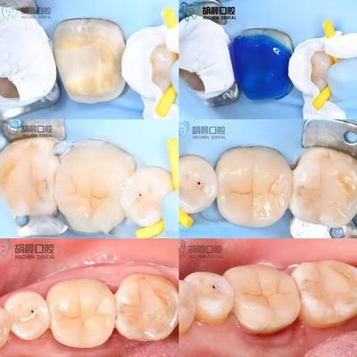 ซื้อ สัมผัสความแม่นยําของฟันในราคาถูกและสีขาวสําหรับความเหมาะสม การผลิตออนไลน์