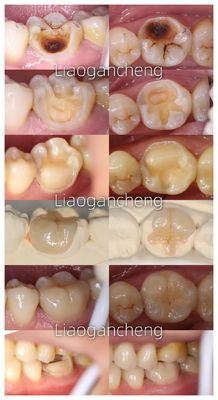 ซื้อ โปรเซลีนฟัน Inlay การฟื้นฟูสําหรับผู้ใหญ่และเด็ก การผลิตออนไลน์
