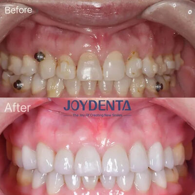 ซื้อ เคลือบฟันเทียมสำหรับฟันที่หายไป | บริการห้องปฏิบัติการทันตกรรมระดับพรีเมียมระดับโลก การผลิตออนไลน์