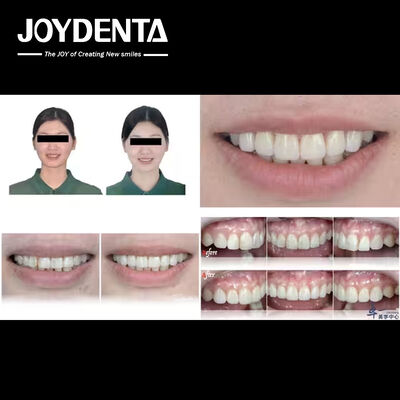 ซื้อ ผลิตภัณฑ์ยอดนิยมของ Joydentalab: วีเนียร์เพื่อความสวยงามจำลอง การผลิตออนไลน์