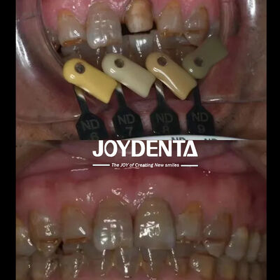 ซื้อ เทคโนโลยีการเรียงชั้นหลายชั้นสําหรับการเรียงแสงที่ดีที่สุดและความเข้ากันได้ในทางชีวภาพระยะยาว การผลิตออนไลน์