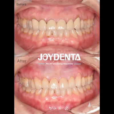 ซื้อ ซิรคอนีฟันที่ทนต่อการหักสูง สําหรับเนื้อเยื่อปากที่ปลอดภัยและความเข้ากันได้ของ CAD / CAM การผลิตออนไลน์