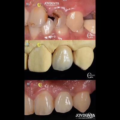 ซื้อ ความเป็นจริงของฟัน ลักษณะของฟัน Zirconia Bridges การฟื้นฟูฟันฟัน ทนทานการสวมใส่ การผลิตออนไลน์