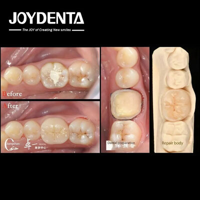 ซื้อ ความเข้ากันได้ทางชีวภาพและเข้ากันได้สูง กับฟันธรรมชาติ การฟื้นฟูฟันฟัน การผลิตออนไลน์