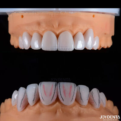 ซื้อ การทําฟันแบบ Custom Emax เซรามิค veneers ด้วยความทนทานกับคราบกระจ่างสูง การผลิตออนไลน์