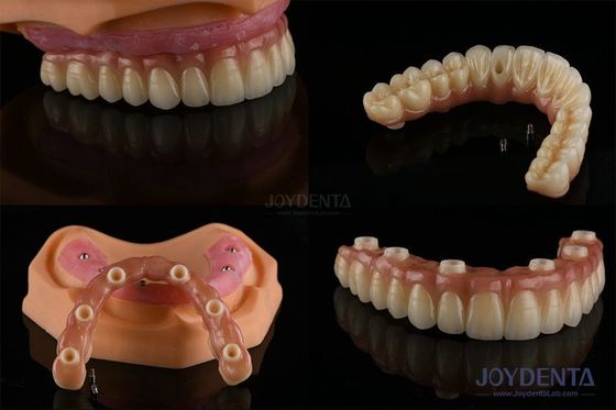 Ivoclar Implant Ball Attachments วัสดุการปลูกฟันที่ถอดได้ สําหรับความสะอาดทางปาก