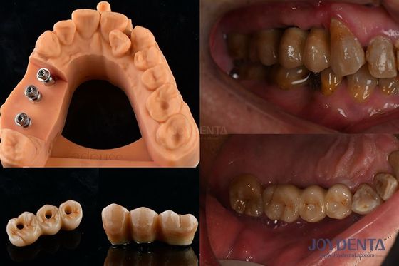 Ultra Hard Color Stability Dental Implant Crown OEM สะดวกในการบํารุงรักษา ใช้ได้นาน