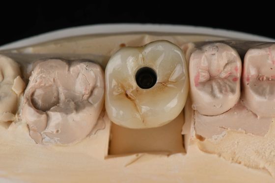 ไทเทเนียม 10 มิลลิเมตร ฟันเดียว ผ่าตัดฟัน แทน Abutment ตัวเอง Tapping ทราย