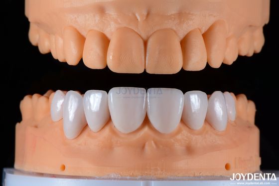 ปลอดภัยเหมาะสม Porcelain Veneers เซรามิกและธรรมชาติ Aesthetics ด้วยความแน่นแข็งแรง