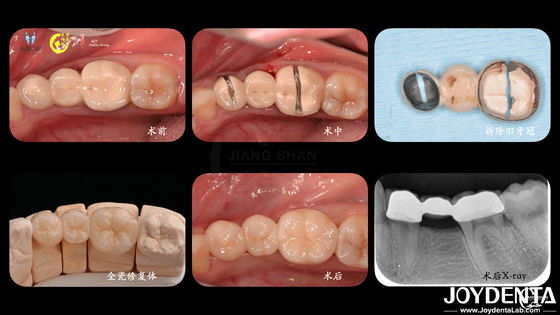 การปรับปรุงสีฟันที่เหมาะสม สี Zirconia Crown Biocompatibility ความสะดวกสบาย การปรับปรุงเพื่อประสบการณ์ผู้ป่วยที่ดีที่สุด