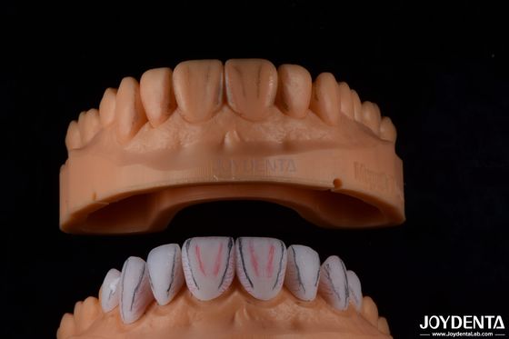 การทําฟันแบบ Custom Emax เซรามิค veneers ด้วยความทนทานกับคราบกระจ่างสูง
