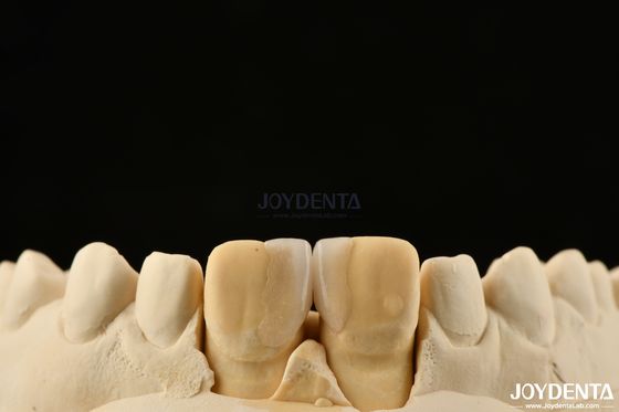 0.2 มม ความหนา Microthin Veneers กระจกเซรามิกฟัน Veneers สําหรับฟันด้านหน้า