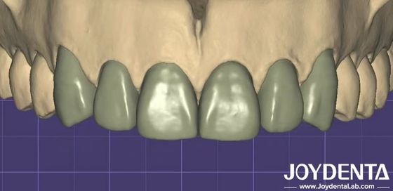 การพิมพ์ 3 มิติ Virtual Digital Wax Up ความสอดคล้องได้อย่างต่อเนื่องกับโปรแกรมทันตแพทย์อื่นๆ