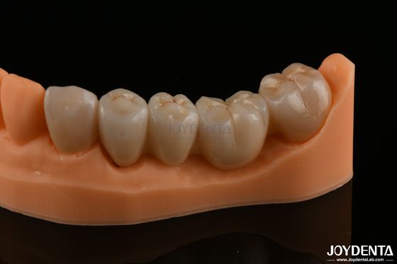 การฟื้นฟูฟันอย่างแม่นยํา สีธรรมชาติ