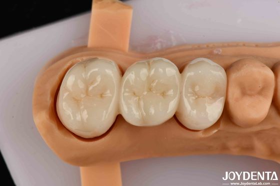 ความแข็งแกร่งในการบิดสูง Zirconia ครบวงจรสําหรับมงกุฎ สะพาน การฟื้นฟูฟัน