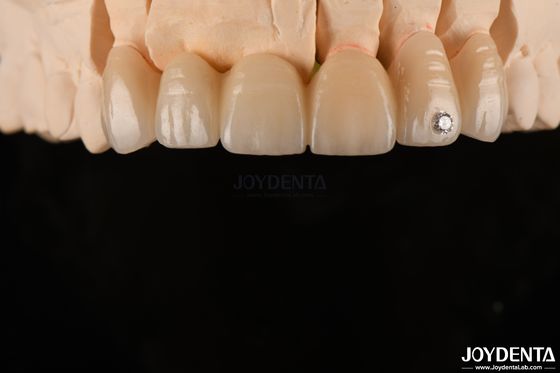 CAD / CAM Milling ทันตแพทย์ Zirconia ชั้นสําหรับราชสีมาเดียว 0.3-0.5mm ความหนาชั้น