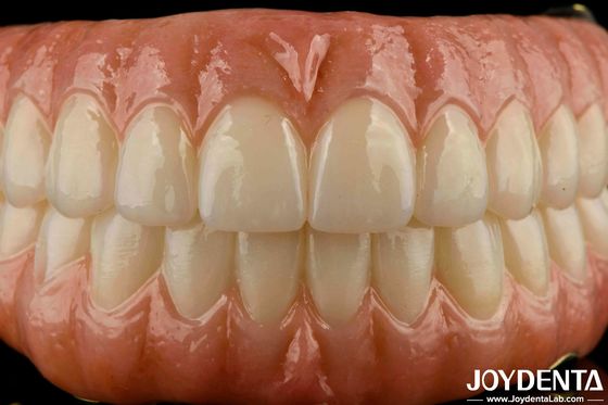 สายฟันที่เหมาะสมอย่างแม่นยํา Ti-Bar Zirconia Hybrid Bridge สําหรับฟันที่หายไป