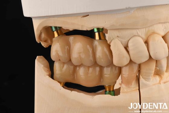 4.5 มม ความสูง สีขาวภายใน Hex ปลูกฟัน Abutments รูปทรง V สกรูเก็บ