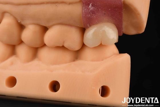 4.1 มิลลิเมตร V รูปทรงเส้น Titanium Abutments กับการเชื่อมต่อ Hex ภายใน