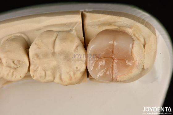 สะอาดง่าย Emax Inlays และ Onlays Hypoallergenic Biocompatible การฟื้นฟูฟัน