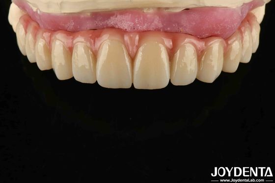 สะดวกสบาย Wear ทิตาเนียม Malong Hybrid Bridge ฟันปรับออกแบบ น้ําหนักเบา