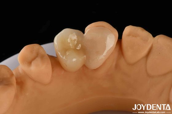 Emax Maryland Veneer Clinical Bonding Adhesion สําหรับการซ่อมแซมฟันที่ตรงกับสี
