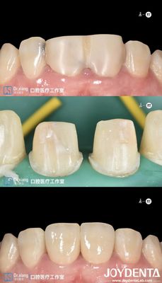 ฟันที่เหมาะสมอย่างสมบูรณ์แบบ สร้อยฟันซิกโอนี กับระบบ CAD CAM สําหรับการผลิตแม่นยํา