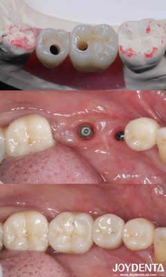 กระบอกทั้งหมดบน 4 ทิตาเนียมปลูกฟัน 10-16mm ความยาว Hex การเชื่อมต่อ