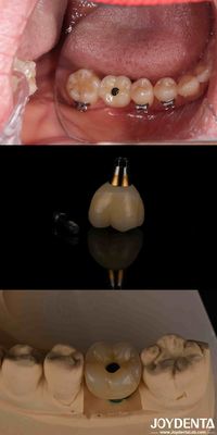 4-6 ฟัน Endosseous Conical Implant ระดับกระดูกภายใต้กระดูกและการเชื่อมต่อ Hex ภายใน