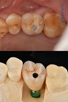 ทิตาเนียม อุปกรณ์ปลูกฟันแบบกระดูกเต็ม โปรเทสต์ 4.1 มม สําหรับความทนทานที่พิเศษ