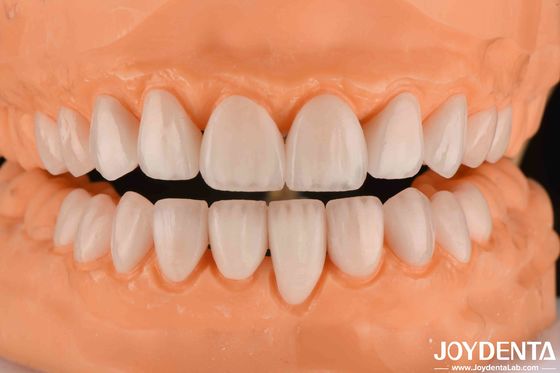 เซรามิค Emax Veneers ความหนา 0.3-0.5 มิลลิเมตร ความยาวนาน โคสเมติก โปรเซลีน Veneers