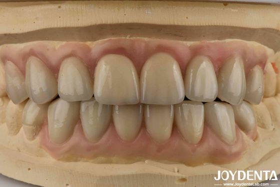 ผ่านแสงสูง Emax การเสริมความงาม การรักษาฟัน Veneers Aesthetics สูง Ultra Thin