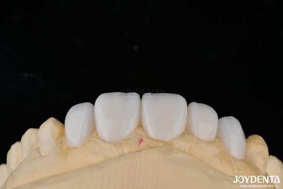 การปรับปรุงวัสดุโพรเซลน Emax ฟัน veneers สําหรับความสวยงามสูง bonding