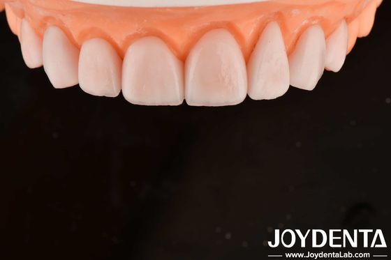 สูตร IPS โปรเซลีน Emax Veneers การฟื้นฟูฟัน