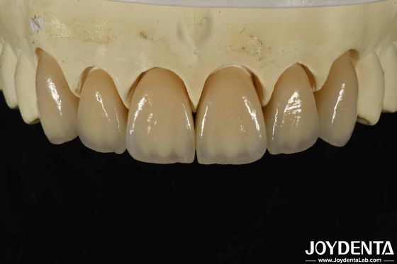 ความเหมาะสมทางชีวภาพที่ดีมาก Zirconia แผ่นภายในความสวยงามสูงและความหนาแน่น 6.0-6.1 G / cm3