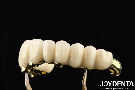 สะดวกต่อการสวมผ้า Ti-Bar Zirconia Hybrid Bridge กลับคืนการเคี้ยว