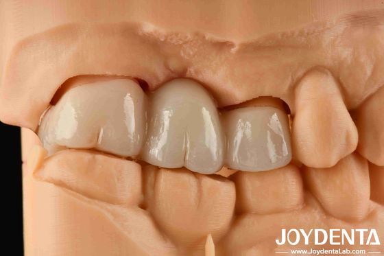 ประสบการณ์ สีจริง อะซิรกอนีเต็ม ด้วยความทนทานสูงต่อสีและความแข็งแรง flexion ของ 1000 MPa
