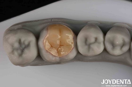 ทนต่อการสวมและฉีกโปร่งใสดี ความแข็งแรงต่ํา Emax Inlay Onlay สําหรับประสิทธิภาพการดําเนินงานของคุณ